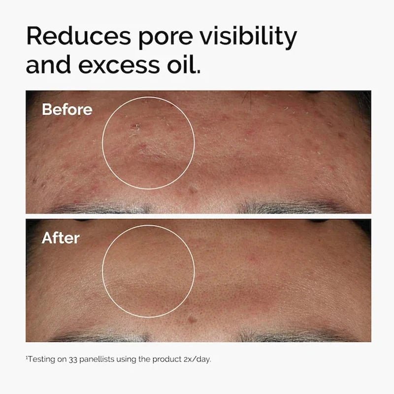Niacinamide Serum Essence Suitable for Acne-prone Skin Which Can Smooth Brighten Support The Skin - princesszohal